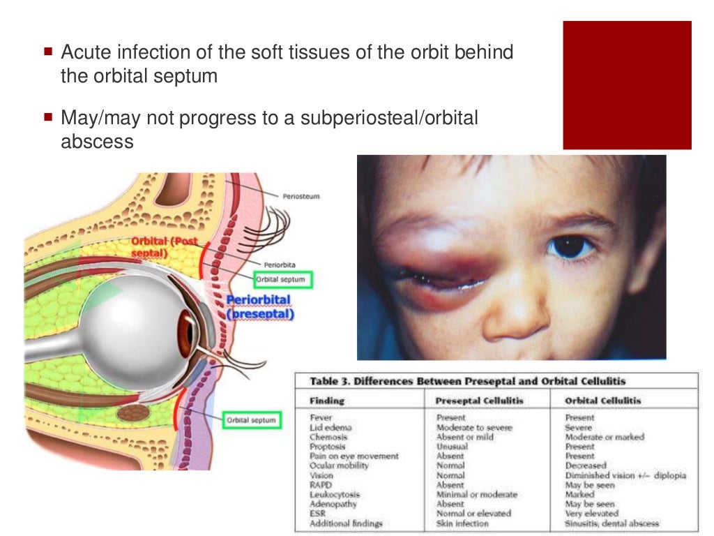 Orbital Cellulitis Orbital Cellulitis