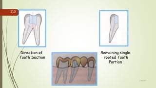 Direction of
Tooth Section
Remaining single
rooted Tooth
Portion
110
5/28/2017
 