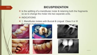 BICUSPIDIZATION
 Is the splitting of a mandibular molar & retaining both the fragments
so as to change the molar into two separate units.
 INDICATIONS
 1. Mandibular molars with Buccal & Lingual Class II or III
Furcation involvements.
111
5/28/2017
 