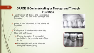 GRADE III Communicating or Through and Through
Furcation
 Destruction of bone and connective
tissue wall all the way through the
furcation
 Bone is not attached to the dome of
furcation.
 Early grade III involvement- opening
filled with soft tissue
 Pocket formation  completely
probable to the opposite side of the
tooth
 Radiographic evidence  small
triangular radiolucency
18
5/28/2017
 