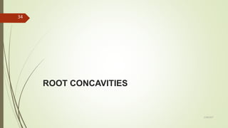ROOT CONCAVITIES
34
5/28/2017
 