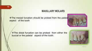 MAXILLARY MOLARS
The mesial furcation should be probed from the palatal
aspect of the tooth
The distal furcation can be probed from either the
buccal or the palatal aspect of the tooth.
48
5/28/2017
 