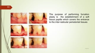 The purpose of performing furcation
plasty is the establishment of a soft
tissue papilla which covers the entrance
to the inter-radicular periodontal tissues
83
5/28/2017
 