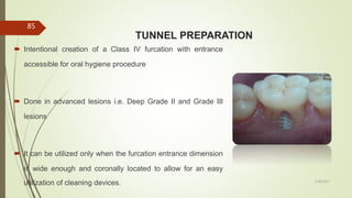 TUNNEL PREPARATION
 Intentional creation of a Class IV furcation with entrance
accessible for oral hygiene procedure
 Done in advanced lesions i.e. Deep Grade II and Grade III
lesions
 It can be utilized only when the furcation entrance dimension
is wide enough and coronally located to allow for an easy
utilization of cleaning devices.
85
5/28/2017
 