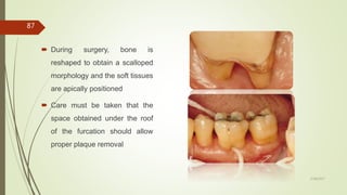  During surgery, bone is
reshaped to obtain a scalloped
morphology and the soft tissues
are apically positioned
 Care must be taken that the
space obtained under the roof
of the furcation should allow
proper plaque removal
87
5/28/2017
 
