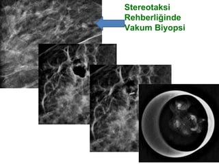 Stereotaksi
Rehberliğinde
Vakum Biyopsi
 