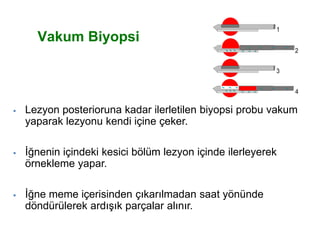 1
2
3
4
 Lezyon posterioruna kadar ilerletilen biyopsi probu vakum
yaparak lezyonu kendi içine çeker.
 İğnenin içindeki kesici bölüm lezyon içinde ilerleyerek
örnekleme yapar.
 İğne meme içerisinden çıkarılmadan saat yönünde
döndürülerek ardışık parçalar alınır.
Vakum Biyopsi
 