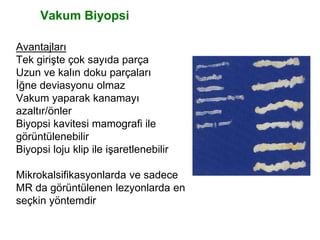 Vakum Biyopsi
Avantajları
Tek girişte çok sayıda parça
Uzun ve kalın doku parçaları
İğne deviasyonu olmaz
Vakum yaparak kanamayı
azaltır/önler
Biyopsi kavitesi mamografi ile
görüntülenebilir
Biyopsi loju klip ile işaretlenebilir
Mikrokalsifikasyonlarda ve sadece
MR da görüntülenen lezyonlarda en
seçkin yöntemdir
 