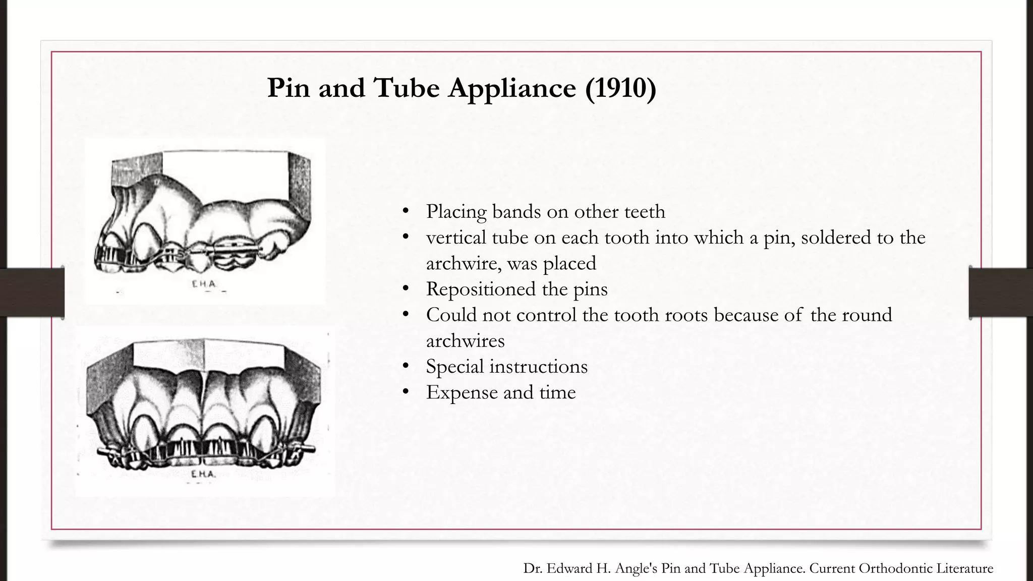 • Placing bands on other teeth
• vertical tube on each tooth into which a pin, soldered to the
archwire, was placed
• Repositioned the pins
• Could not control the tooth roots because of the round
archwires
• Special instructions
• Expense and time
Pin and Tube Appliance (1910)
Dr. Edward H. Angle's Pin and Tube Appliance. Current Orthodontic Literature
 