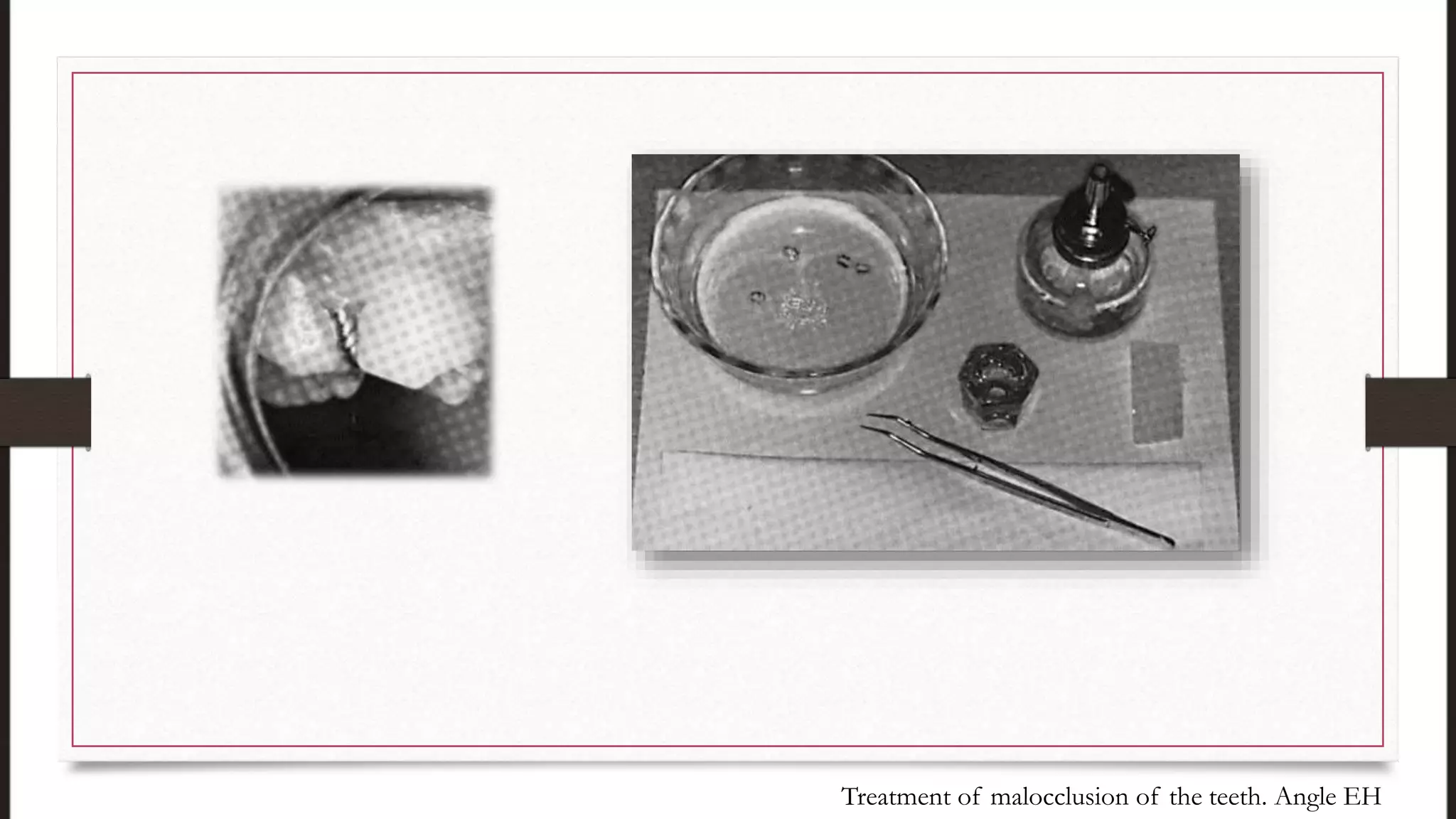 Treatment of malocclusion of the teeth. Angle EH
 