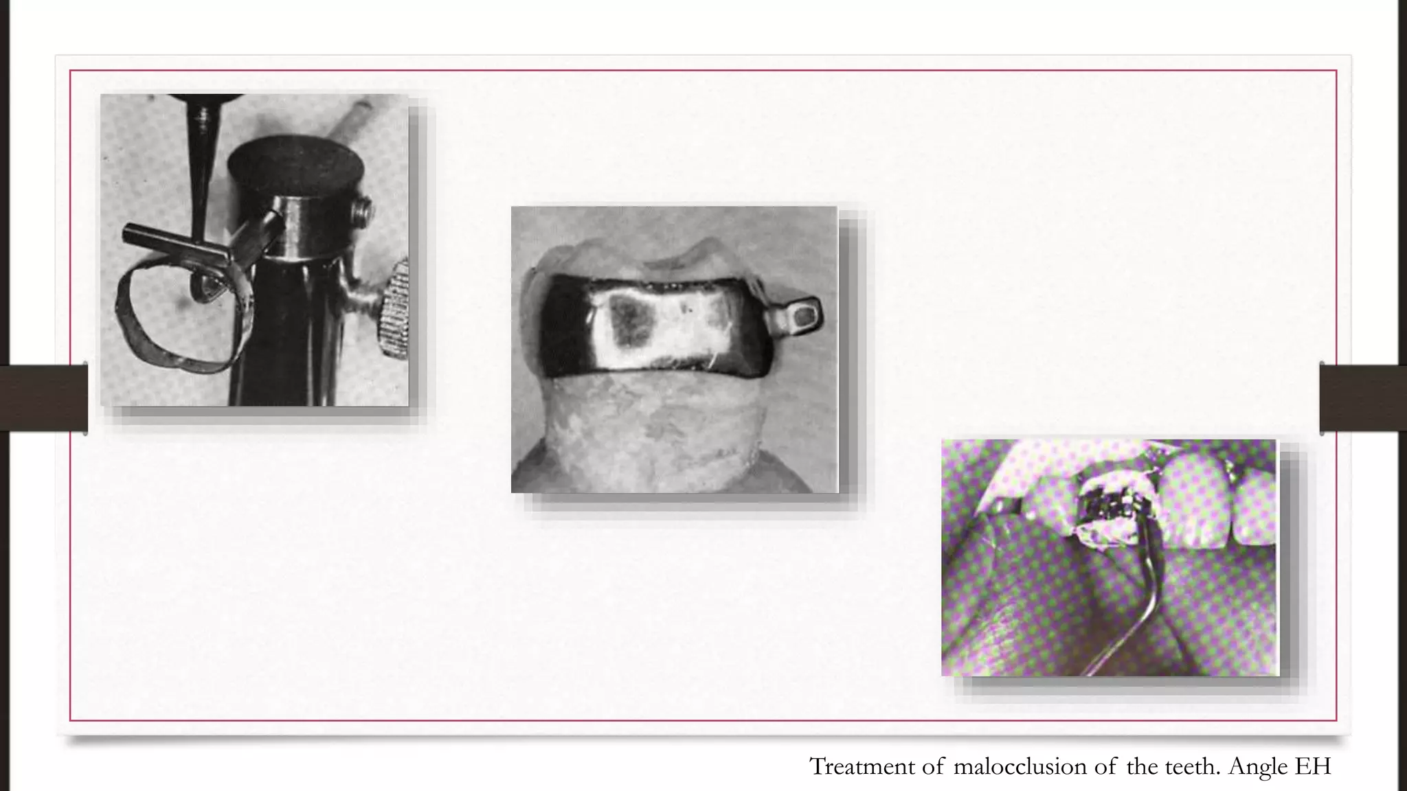 Treatment of malocclusion of the teeth. Angle EH
 