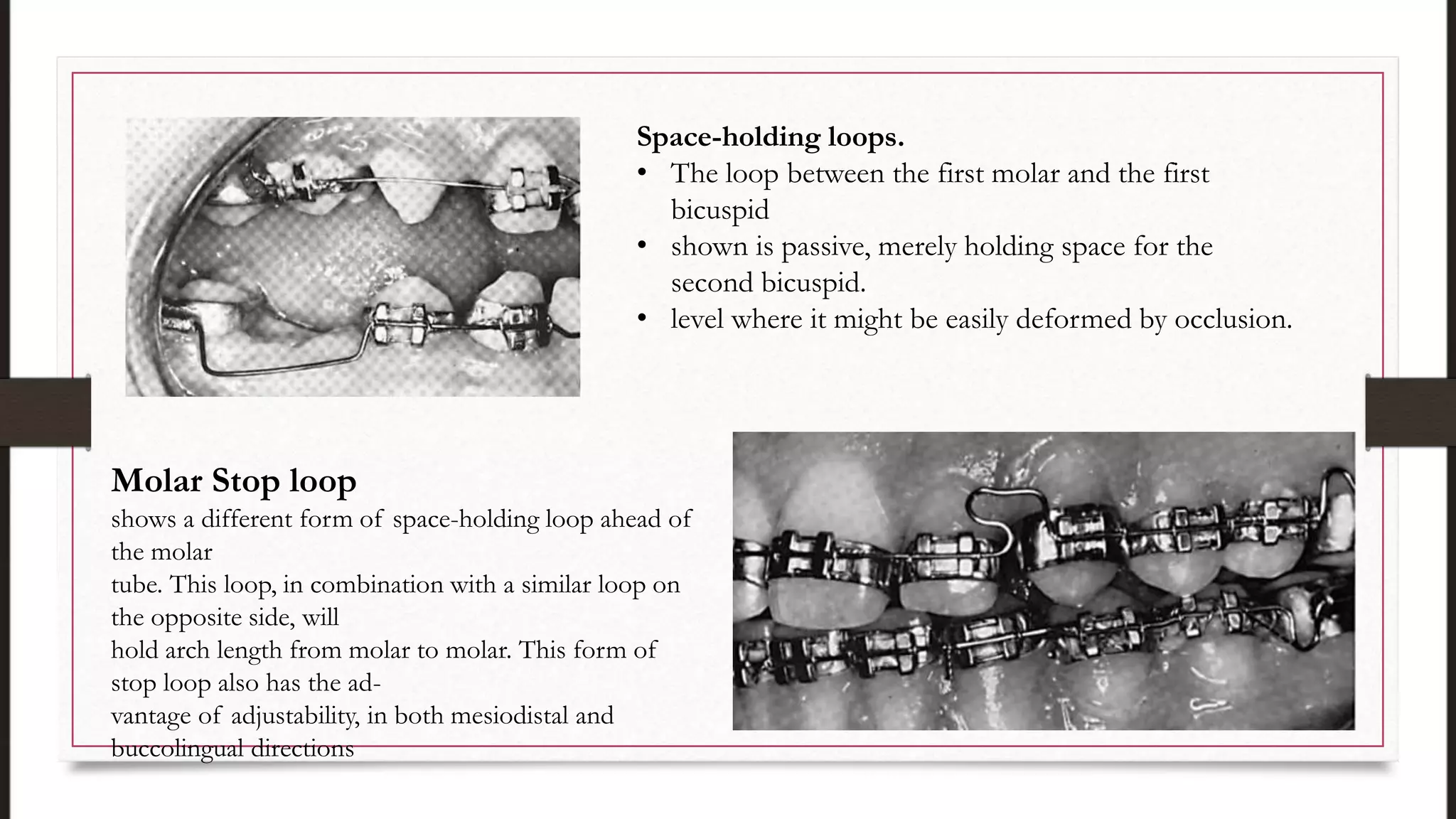 Space-holding loops.
• The loop between the first molar and the first
bicuspid
• shown is passive, merely holding space for the
second bicuspid.
• level where it might be easily deformed by occlusion.
Molar Stop loop
shows a different form of space-holding loop ahead of
the molar
tube. This loop, in combination with a similar loop on
the opposite side, will
hold arch length from molar to molar. This form of
stop loop also has the ad-
vantage of adjustability, in both mesiodistal and
buccolingual directions
 