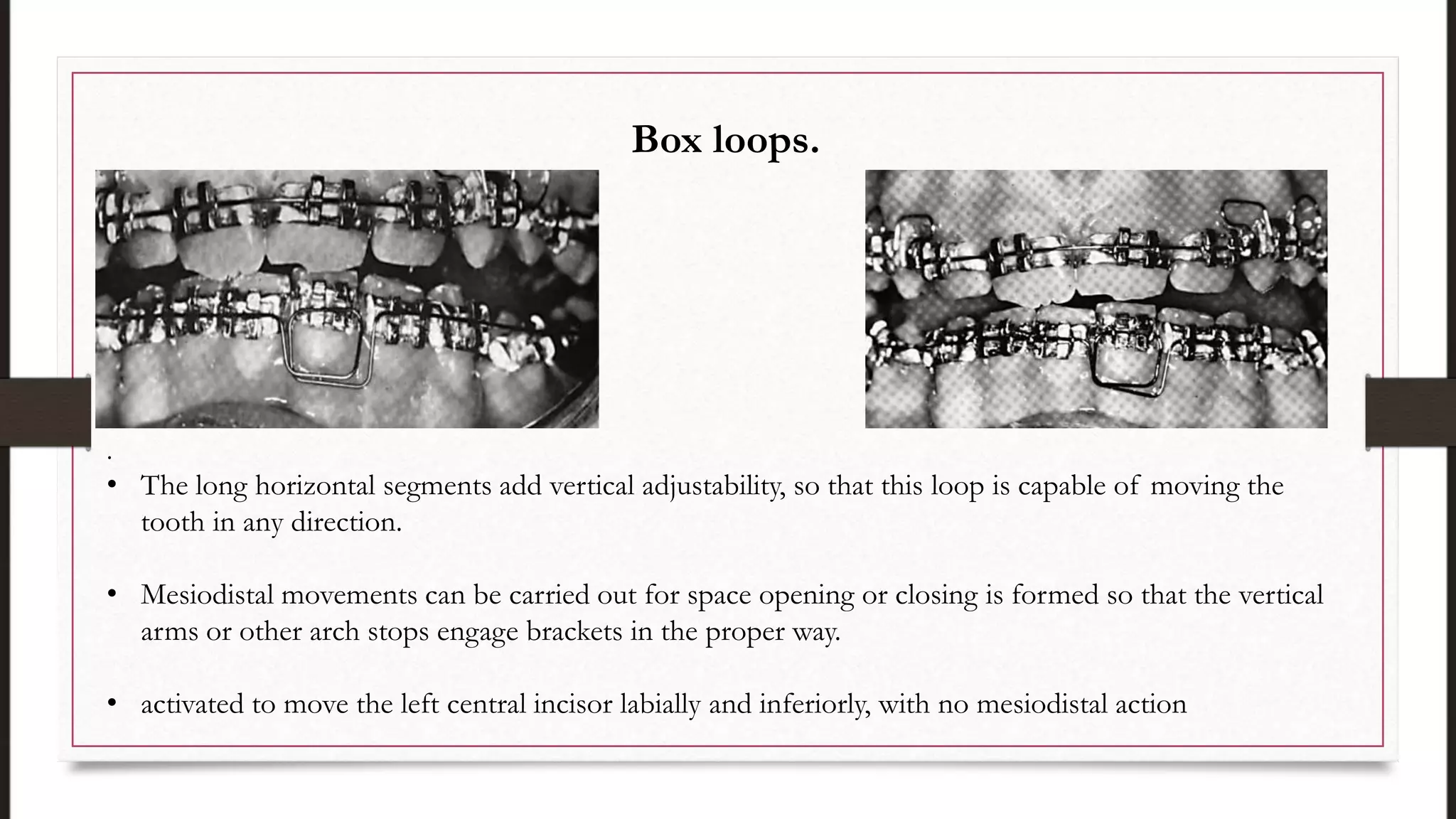.
• The long horizontal segments add vertical adjustability, so that this loop is capable of moving the
tooth in any direction.
• Mesiodistal movements can be carried out for space opening or closing is formed so that the vertical
arms or other arch stops engage brackets in the proper way.
• activated to move the left central incisor labially and inferiorly, with no mesiodistal action
Box loops.
 