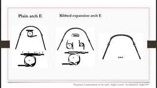 Plain arch E
Treatment of malocclusion of the teeth : Angle's system / by Edward H. Angle(1907
Ribbed expansion arch E
 