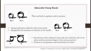 • Strong headed pins soldered to their screw-heads.
• Designed for the treatment of fractures of the maxilla
Plain used both in regulation and in retention
• Smooth-bore tubes soldered to their sides into which the ends of the
arches and the extension ﬂanges of the nuts accurately ﬁt.
• X bands are for premolars and the D bands for molars.‘
Treatment of malocclusion of the teeth : Angle's system / by Edward H. Angle(1907)
Adjustable Clamp Bands
 