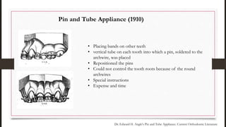 • Placing bands on other teeth
• vertical tube on each tooth into which a pin, soldered to the
archwire, was placed
• Repositioned the pins
• Could not control the tooth roots because of the round
archwires
• Special instructions
• Expense and time
Pin and Tube Appliance (1910)
Dr. Edward H. Angle's Pin and Tube Appliance. Current Orthodontic Literature
 