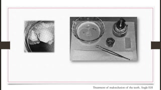 Treatment of malocclusion of the teeth. Angle EH
 