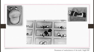 Treatment of malocclusion of the teeth. Angle EH
 