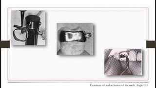 Treatment of malocclusion of the teeth. Angle EH
 