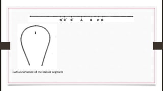 Labial curvature of the incisor segment
 