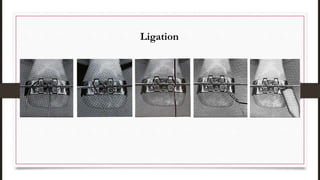 Ligation
 