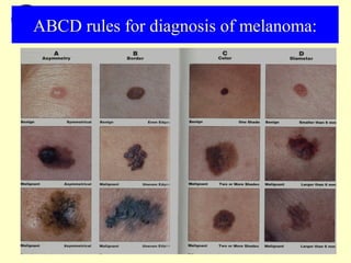 Skin cancer & Malignant Melanoma | PPT