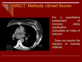 Msvt Score Radiological diagnostics of Cardiovascular System | PPT