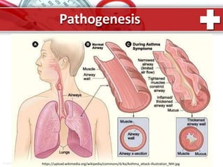 Pathogenesis
ProPo https://upload.wikimedia.org/wikipedia/commons/4/4a/Asthma_attack-illustration_NIH.jpg
 