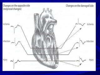 Infarctus Rouge Acute Myocardial Infarction | PPT