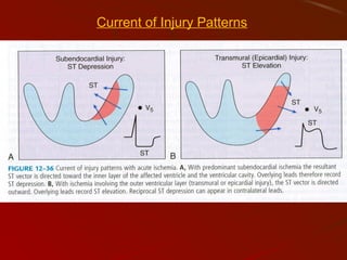 Cord Infarct Pattern Acute Myocardial Infarction | PPT