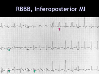 Inferoposterior Infarction Acute Myocardial Infarction | PPT