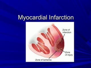 Myocardial InfarctionMyocardial Infarction
 