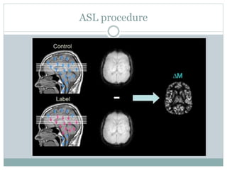 ASL procedure
 