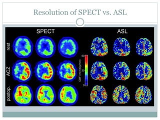 Resolution of SPECT vs. ASL
 