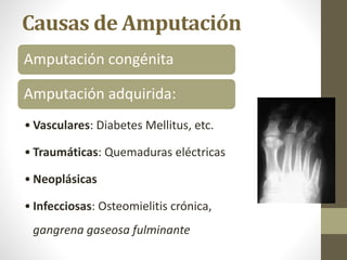 Causas de Amputación
Amputación congénita
Amputación adquirida:
• Vasculares: Diabetes Mellitus, etc.
• Traumáticas: Quemaduras eléctricas
• Neoplásicas
• Infecciosas: Osteomielitis crónica,
gangrena gaseosa fulminante
 