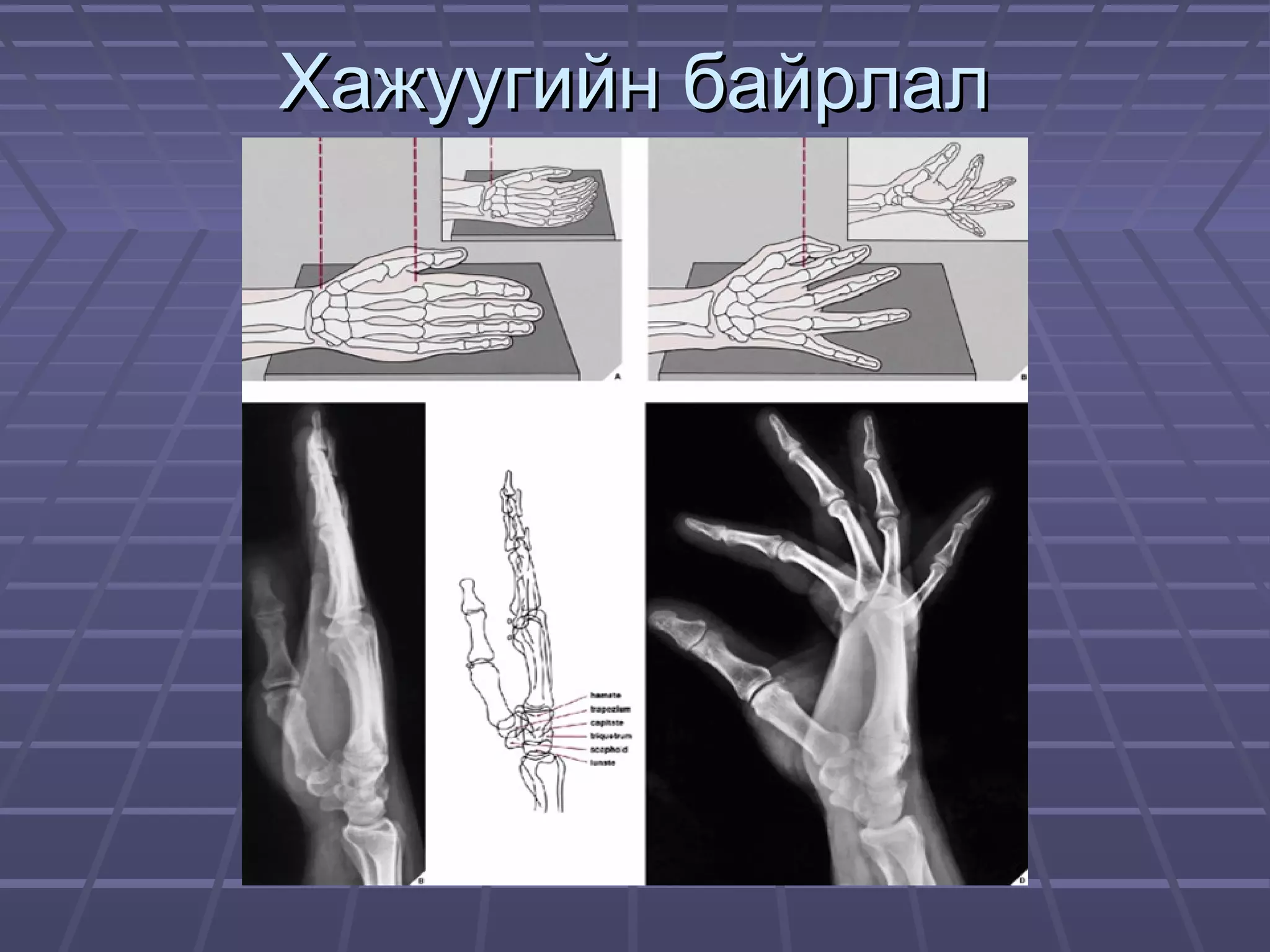 Ж.Билгүүн Гар сарвууны гэмтэл | PPT