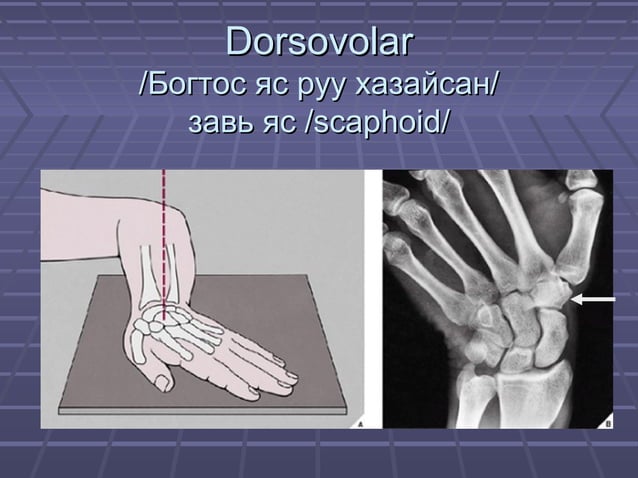 Ж.Билгүүн Гар сарвууны гэмтэл | PPT