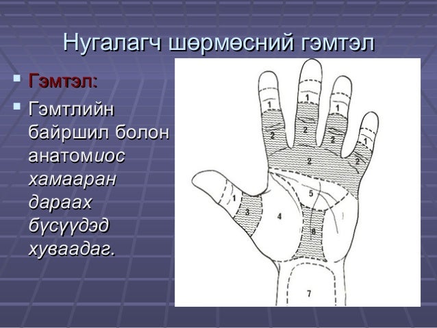 Ж.Билгүүн Гар сарвууны гэмтэл