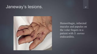 Janeway’s lesions. 27
Hemorrhagic, infarcted
macules and papules on
the volar fingers in a
patient with S. aureus
endocarditis.
 