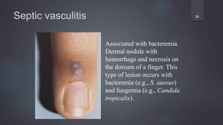 Septic vasculitis 28
Associated with bacteremia.
Dermal nodule with
hemorrhage and necrosis on
the dorsum of a finger. This
type of lesion occurs with
bacteremia (e.g., S. aureus)
and fungemia (e.g., Candida
tropicalis).
 