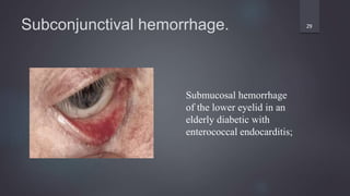 Subconjunctival hemorrhage. 29
Submucosal hemorrhage
of the lower eyelid in an
elderly diabetic with
enterococcal endocarditis;
 