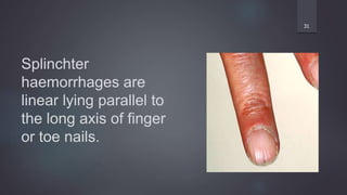 Splinchter
haemorrhages are
linear lying parallel to
the long axis of finger
or toe nails.
31
 