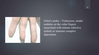 32
Osler's nodes - Violaceous, tender
nodules on the volar fingers
associated with minute infective
emboli or immune complex
deposition.
 