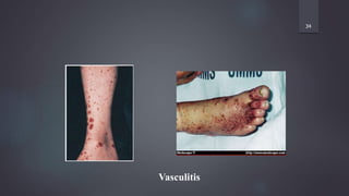 34
Vasculitis
 