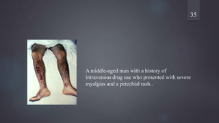 35
A middle-aged man with a history of
intravenous drug use who presented with severe
myalgias and a petechial rash..
 