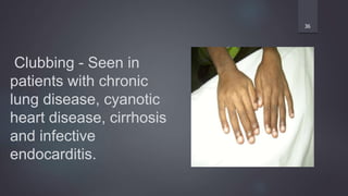 Clubbing - Seen in
patients with chronic
lung disease, cyanotic
heart disease, cirrhosis
and infective
endocarditis.
36
 