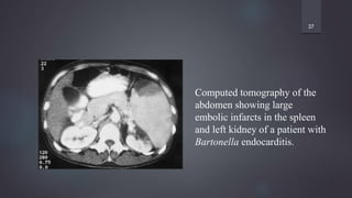 37
Computed tomography of the
abdomen showing large
embolic infarcts in the spleen
and left kidney of a patient with
Bartonella endocarditis.
 