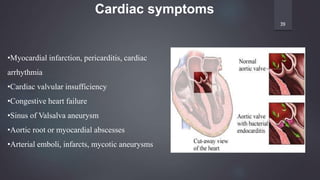39
Cardiac symptoms
•Myocardial infarction, pericarditis, cardiac
arrhythmia
•Cardiac valvular insufficiency
•Congestive heart failure
•Sinus of Valsalva aneurysm
•Aortic root or myocardial abscesses
•Arterial emboli, infarcts, mycotic aneurysms
 