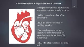 40
In the presence of aortic insufficiency,
vegetations characteristically occur on
(A)The ventricular surface of the
aortic valve.
(B)On the chordae tendinae or
papillary muscles.
(C)In mitral regurgitation, the
vegetations characteristically are
located on the atrial surface of the
mitral valve
(D) At sites of jet lesions on the atrial
wall.
Characteristic sites of vegetations within the heart.
 