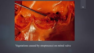 41
Vegetations caused by streptococci on mitral valve
 